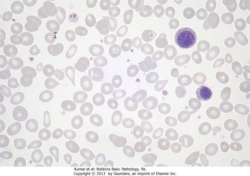Primary myelofibrosis: nucleated erythroid precursors and several teardrop-shaped red cells