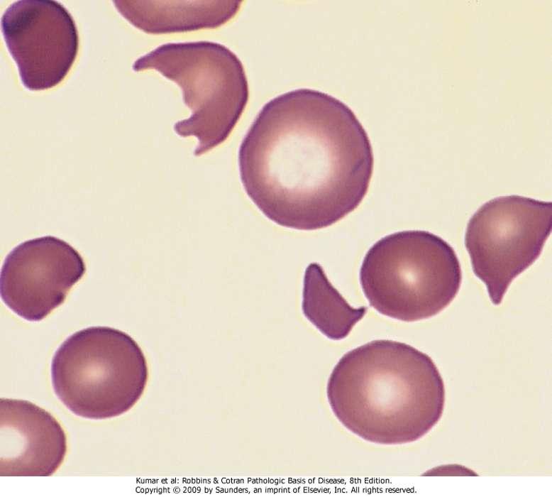 Schistocytes: fragmented RBCs, appear as torn, irregular & different shapes.