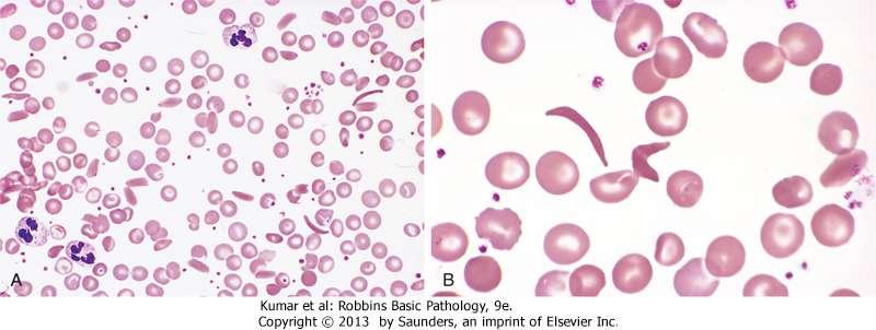 Sickle cells appear as curved cylinders, represent