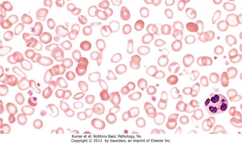 Hypochromic microcytic anemia: RBCs appear small & pale (central pallor >1/3), occur in thalassemia