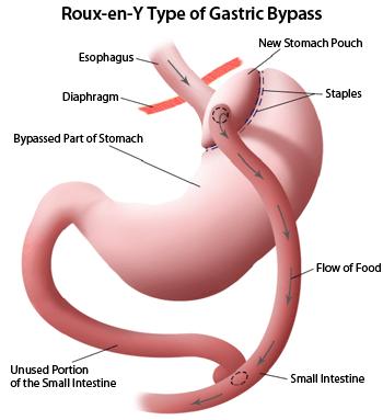 Laparoscopic Roux-en-Y Gastric Bypass Both restrictive and malabsorptive. proximal gastric pouch of small size often 20-30 ml that is totally separated from the distal stomach.