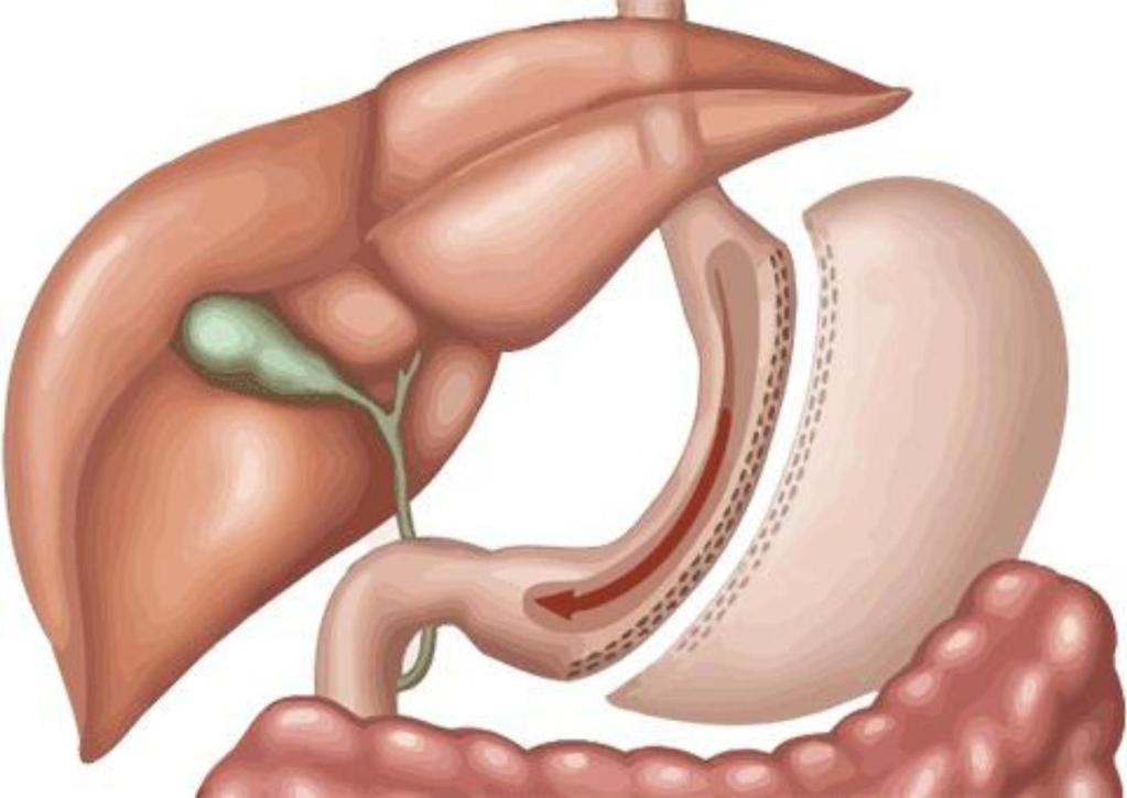 laparoscopic Sleeve gastrectomy The most popular Bariatric procedure nowadays. Creation of small gastric tube over 36-40 Fr.