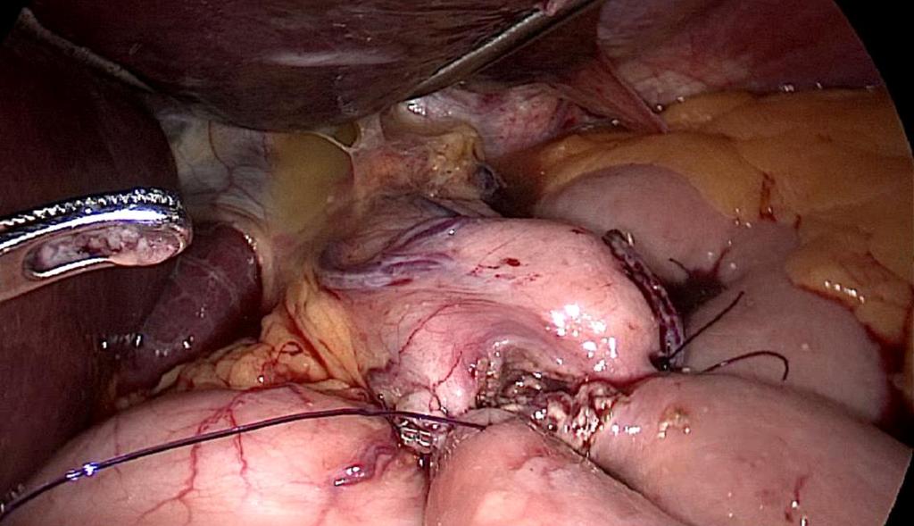 stomach Gastro-jejunal