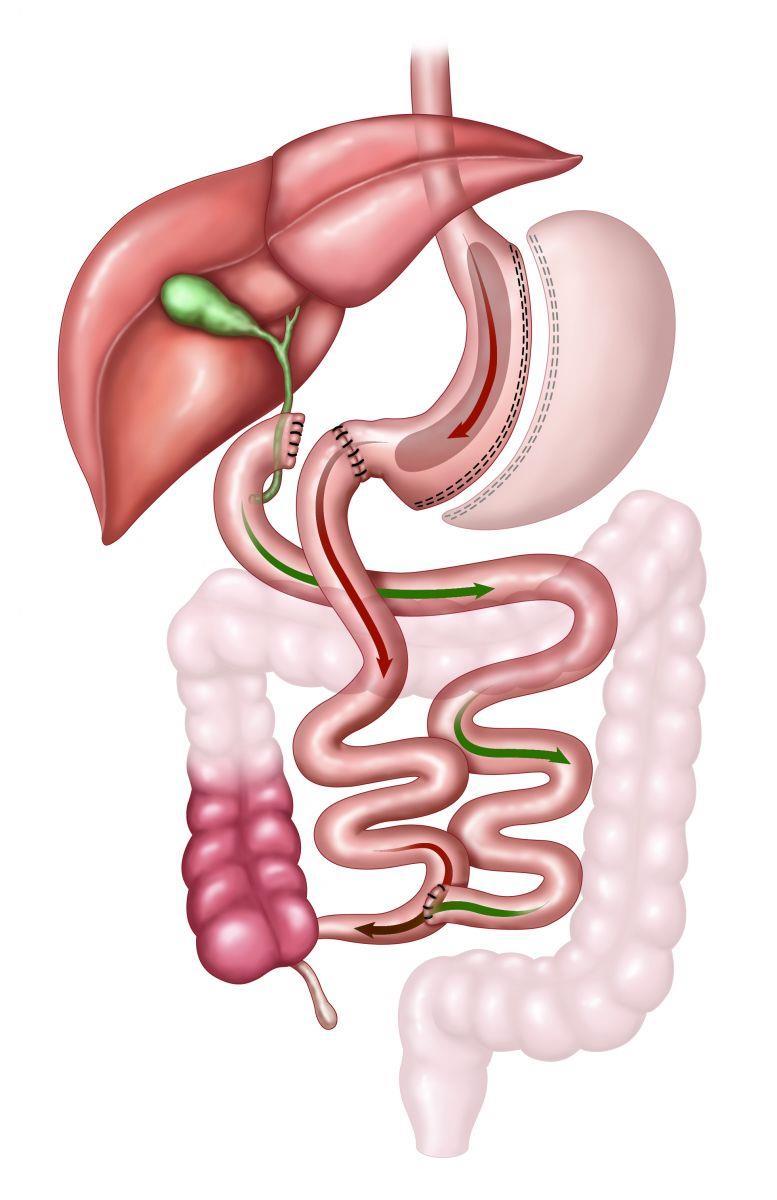 Biliopancreatic Diversion With Duodenal Switch Resected stomach Duodenal-jejunal