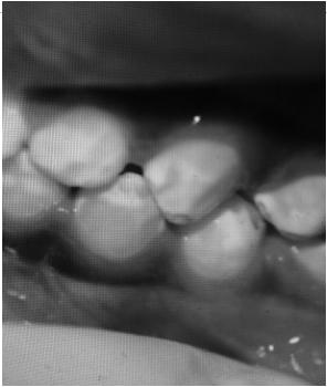 Nutrient Deficiencies Result in oral manifestations - mucous membranes - teeth (enamel defects) - periodontal tissues - salivary glands - perioral skin Dental Enamel Defects Oral