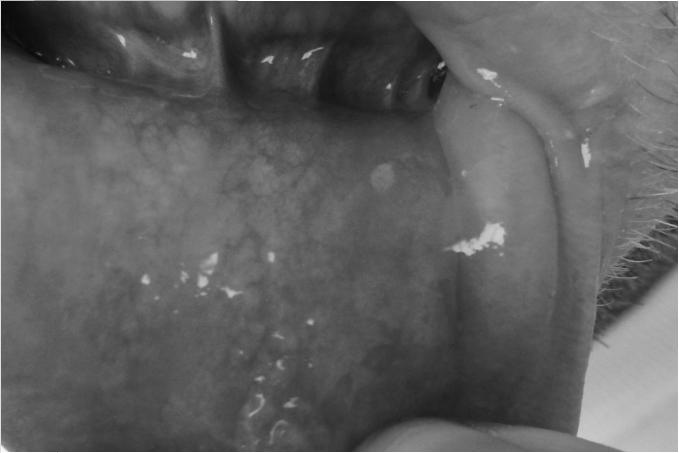 Apthous Ulcers in the Buccal