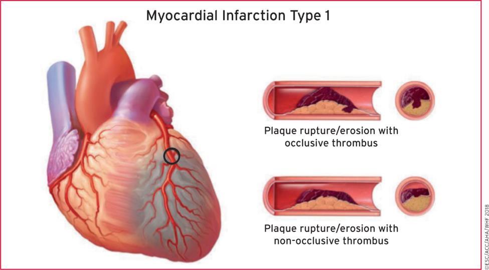 Most cases Treated with early PCI From: Fourth universal definition of myocardial infarction (2018) Eur