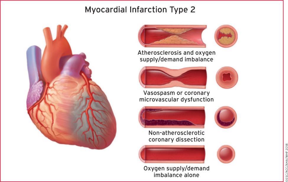 Elective PCI (not all cases) Myocardial ischemia in absence of