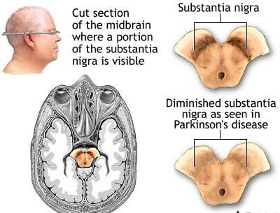 PARKINSON'S DISEASE Parkinson's disease is a clinical syndrome characterized by impairment of movement, rigidity and tremor, which results from damage to the basal ganglia.