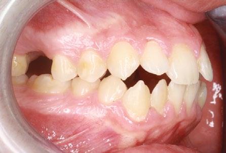 completed with crowding, incisors protrusion,