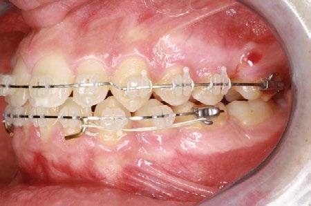 teeth, while a step-up using archwire 0.