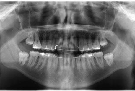 Oral Surgery, Oral Medicine, Oral Pathology, Oral Radiology, and Endodontology,. Volume 107, Issue 2, 2009, Pages 14-20 2. Upper Canine Extractions in Adult Cases with Unusual Malocclusions. G.