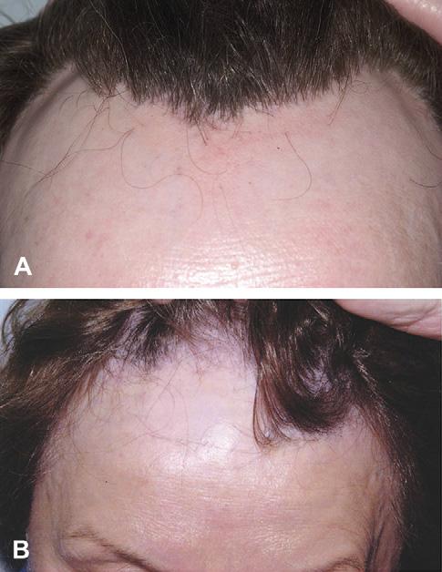 affecting the frontal scalp and crown, which improved with superpotent topical steroids. Eyebrow loss was documented in 44 patients (73%).