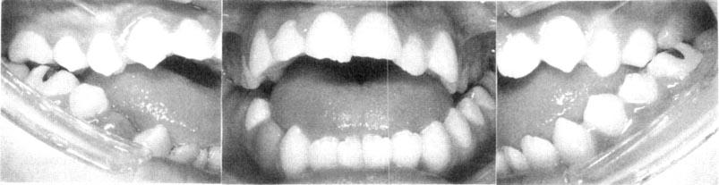 cephalometric radiographs were taken. Fig. 1 Facial photographs Fig.
