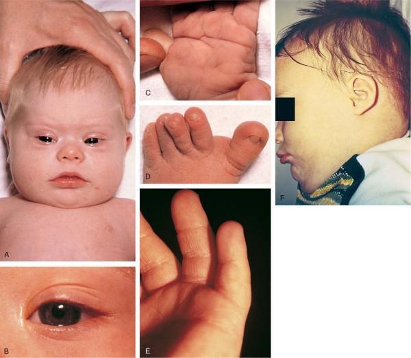 + Down Syndrome (aka Trisomy 21) Epicanthal folds with up-slanting of palpebral fissures Brushfield spots on iris Single