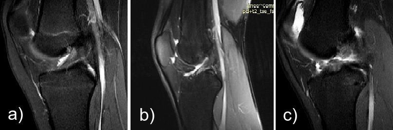 A B C Figure 2: PDFS Sagittal images of knee in different patients showing (A): increased hyperintensity involving the AMB of ACL without disruption of fibers - grade I interstitial ; (B):