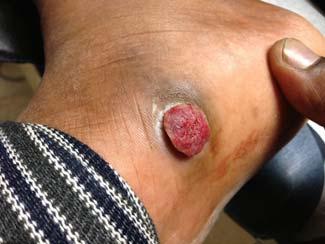 around the neck or face Pts will usually have onychomycosis and tinea pedis as well If on