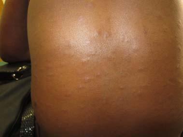 Inflammatory Syphilis Herpes zoster