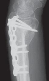 Long-term Results of Dorsally Displaced Distal Radius Fractures Treated With the Pi-Plate: Is Hardware Removal Necessary? MINOS E. TYLLIANAKIS, MD; ANDREAS M.