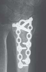 2A 2B 2C 2D Figure 2: Preoperative AP (A) and lateral (B) radiographs of an extra-articular fracture in a 57-year-old woman who sustained the fracture after a fall from a height.
