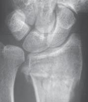 Table Radiographic Measurements Median (range) Radial Shortening, mm Sagittal Tilt, deg Radial Inclination, deg Intra-articular Step, mm Preoperatively 5 ( 5 to 14) 18 ( 45 to 26) 10 ( 20 to 21) 5