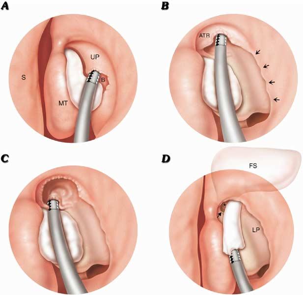 Landsberg et al A Targeted Endoscopic Approach to Chronic... 29 minal recess or the agger nasi or frontal cell, 2 sparing the ethmoid bulla and the natural maxillary ostium.