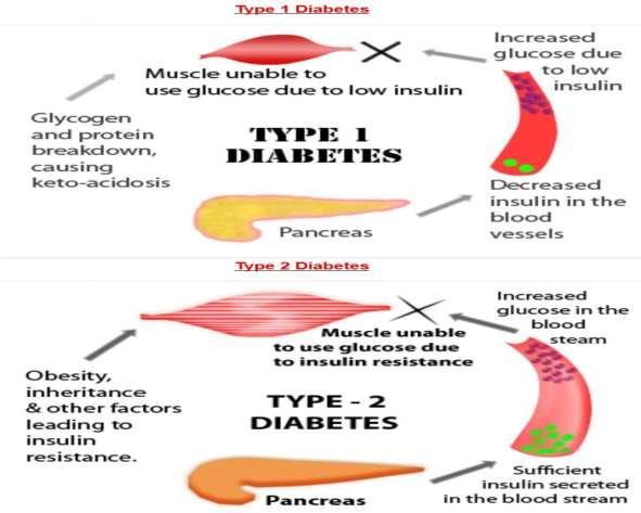 Type 2 diabetes Definitin Type 2 diabetes, nce knwn as adult-nset r nninsulin-dependent diabetes, is a chrnic cnditin that affects the way yur bdy metablizes sugar (glucse), yur bdy's imprtant surce