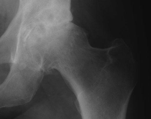 The radiographs should clearly demonstrate the acetabular configuration and the endosteal and periosteal contours of the femoral head, neck and proximal femur (Figure 2).