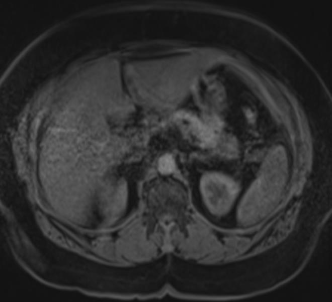 Pancreatic MRI T1 w T1 FS w
