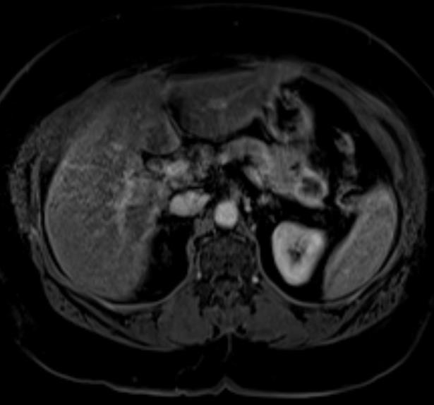 Question 1 What is the most likely diagnosis? 1. Mass-forming chronic pancreatitis? 2.