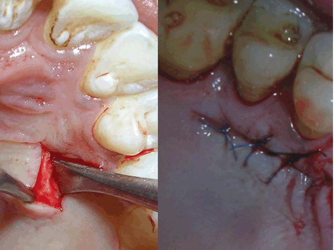 [4] (Figure 4). Lui s had classified incisions for harvesting the connective tissue graft from palate [5].