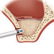 4 5 Grafting material is placed beneath the sinus membrane alongside the existing bone.