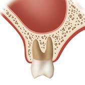 When there is insufficient bone available to securely place a dental implant, the sinus membrane must be lifted in order to create space for placing additional bone in that area.