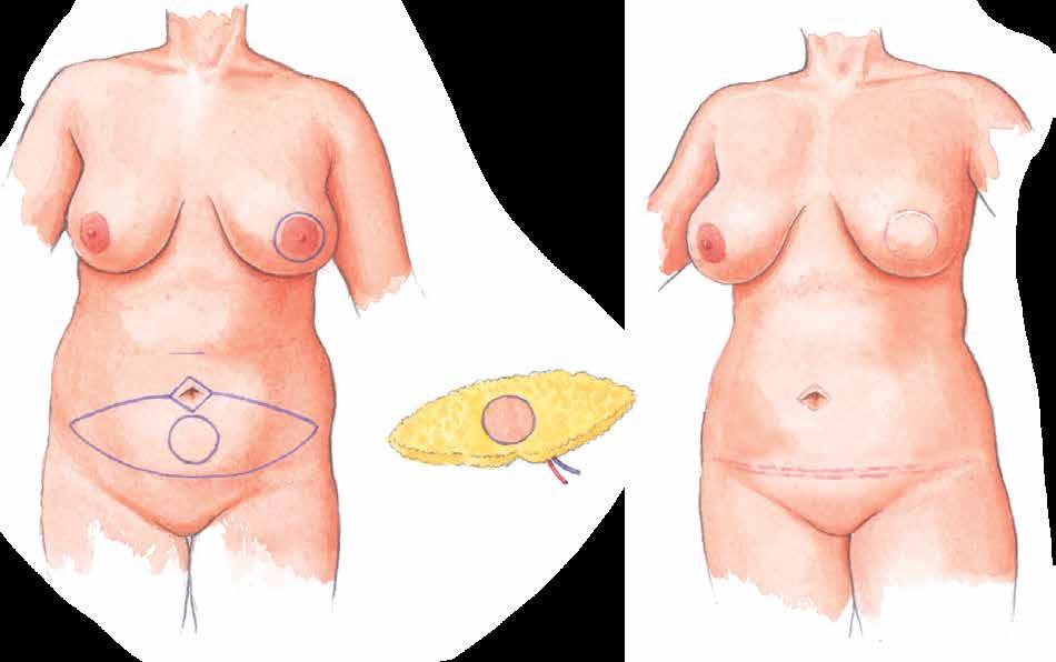 BREAST RECONSTRUCTION USING A DEEP INFERIOR EPIGASTRIC PERFORATOR (DIEP) FLAP This fact sheet is for women who are having a breast reconstruction using a DIEP flap, or are considering having a DIEP