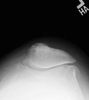 Primary PF DA No subluxation Pain in Flexion is due to Lateral Patellar Pressure Pressure occurs as the lateral patellar facet is compressed over the lateral femoral condyle as the knee flexes With