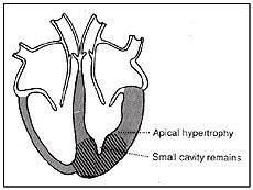 Cardiomyopathy
