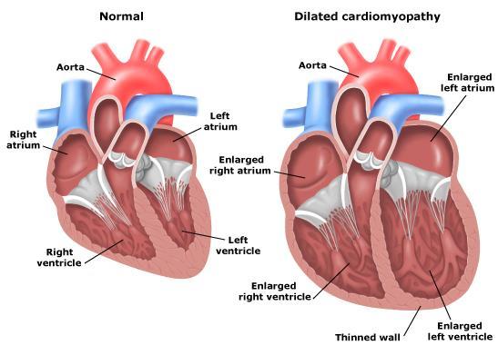 Dilated Cardiomyopathy (DCM) Key features Dilated (enlarged) ventricle Systolic dysfunction Reduced