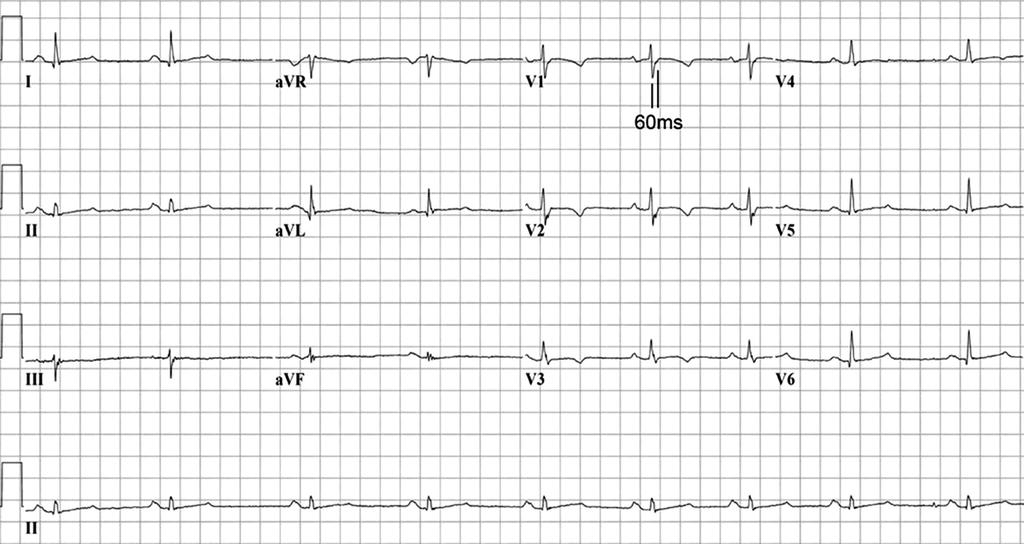 ECG from a proband with ARVC Prolongation of terminal activation >=55 ms from S to