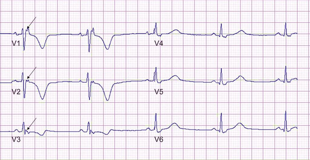 ECG from a proband with ARVC epsilon wave Prolongation of terminal activation