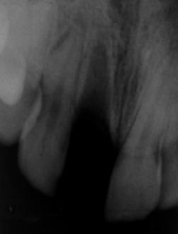 Thereafter, the avulsed tooth (11) can be eventually replaced by an implant. However, due to the patient s limited financial means, she could not afford an implant or any prosthetic solution.