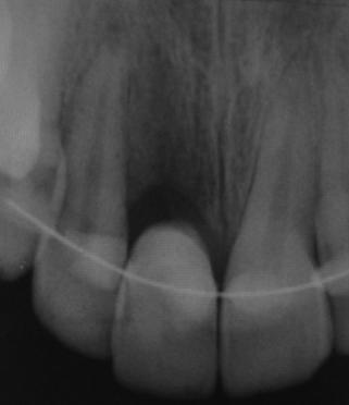 So the alveolar healing process was advanced. In addition, the labial (vestibular) wall of alveolar socket was lost. Thereby the tooth replantation became unfeasible.