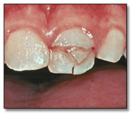 papilla and even inflamed periapical tissue into the root canal after canal disinfection with a triple antibiotic paste and evoked bleeding after instrumentation.