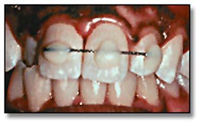 If the tooth is mobile and the patient expresses discomfort, the coronal fragment should be extracted.