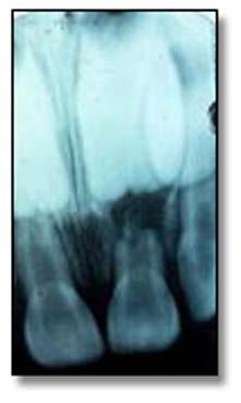Radiographic examination reveals the tooth to be in its normal position in the socket. be performed. If root resorption is present, extraction is recommended.