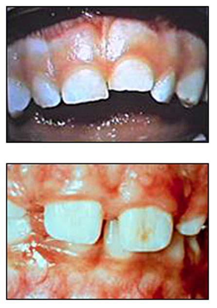 In the primary dentition follow up treatment is clinical observation at two-to-three weeks and clinical observation and radiographs at six-to-eight weeks and one year.