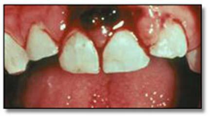 Extrusion Follow up treatment: Primary teeth: Clinical observation after one week.