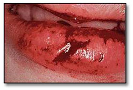 Lips often cushion the teeth during a fall, bearing the brunt of the injury and resulting in bruises and lacerations.