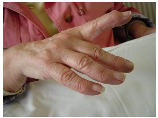 Treatment If left untreated, mallet finger can lead to a swan neck deformity.
