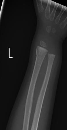 Buckle fracture of