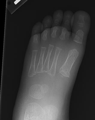 1 st Metatarsal Buckle fracture Cast or